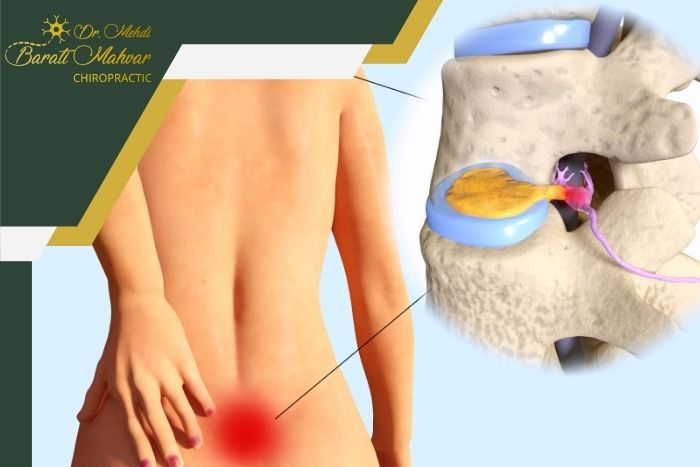 تفاوت دیسک خفیف و شدید از نظر پزشکی