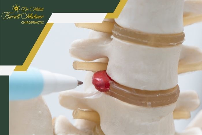 محدودیت‌ها و خطرات کایروپراکتیک در دیسک شدید